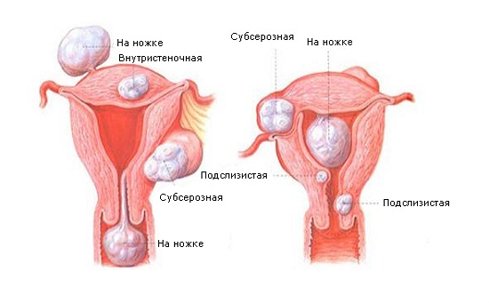 Фибромы матки
