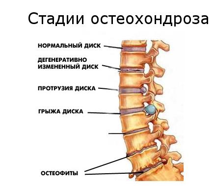 Стадии остеохондроза позвоночника